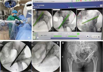 Analysis of the therapeutic efficacy of robot-assisted percutaneous screw fixation in the minimally invasive treatment of pelvic fractures